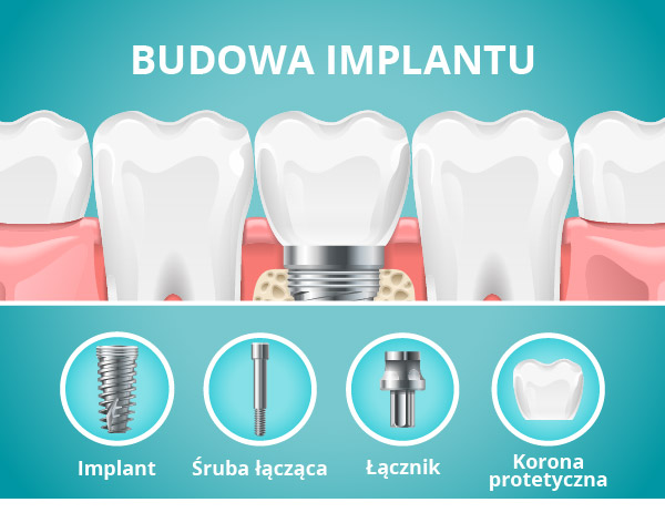 budowa implantu zęba